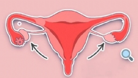 卵巢早衰与卵巢功能低下不可怕 试管婴儿来助孕