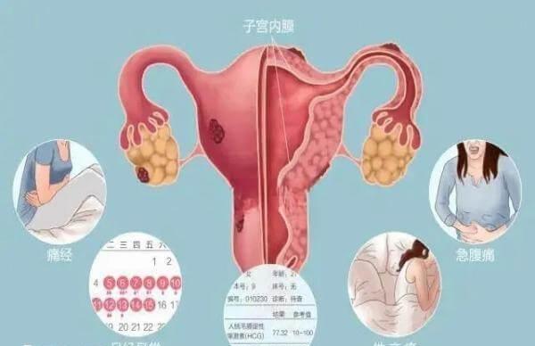 应对子宫内膜异位症最好的手段是预防