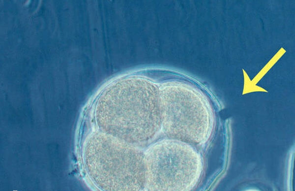 高龄可以做胚胎辅助孵出