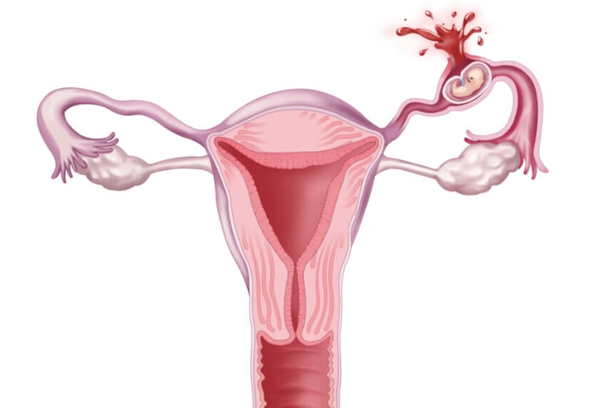 宫外孕,hCG分泌量很低