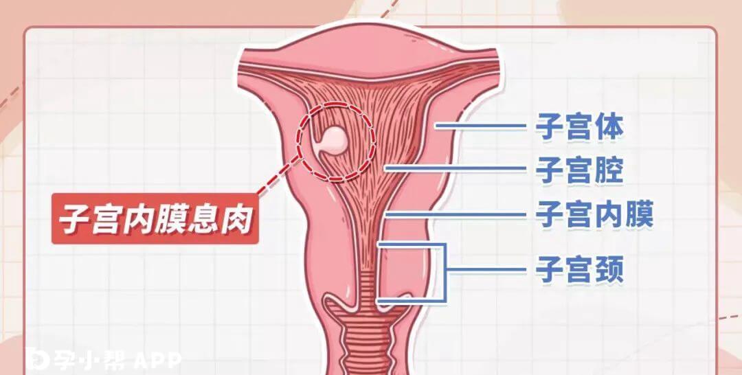 子宫内膜息肉会影响怀孕