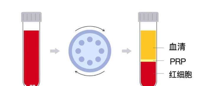 PRP含有高浓度的生长因子