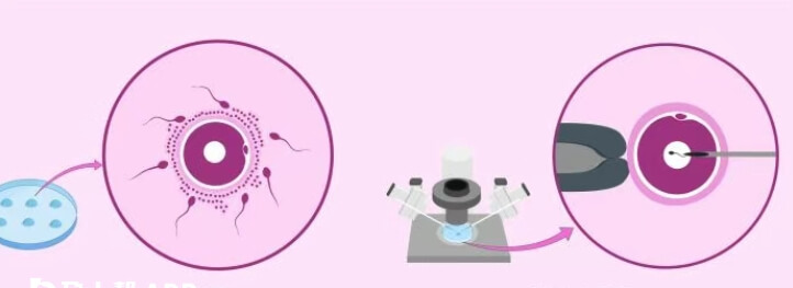 一代转二代用我们专业术语称为补救ICSI