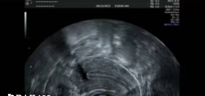 A型内膜有明确的三线征