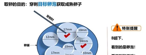 取卵是获取成熟卵子