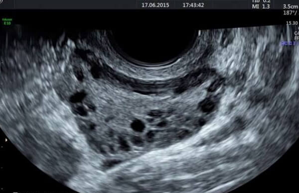 生活方式干预是多囊卵巢综合征患者首选的基础治疗