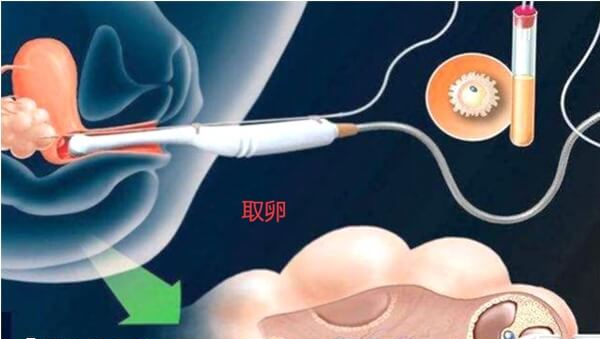 取卵需要男女双方同时就诊