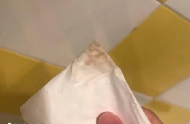 试管着床失败排出分泌物为褐色或浅红色