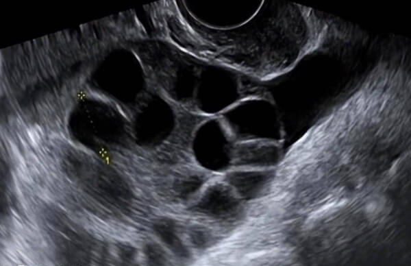 促排过程中卵巢体积会出现增大