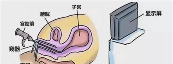 做宫腔镜比较痛苦