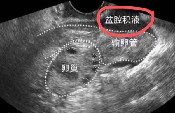 盆腔积液分生理和病理