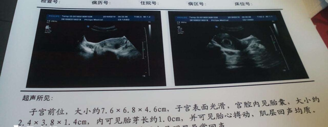 移植怀孕4到5周能验出胎心胎芽