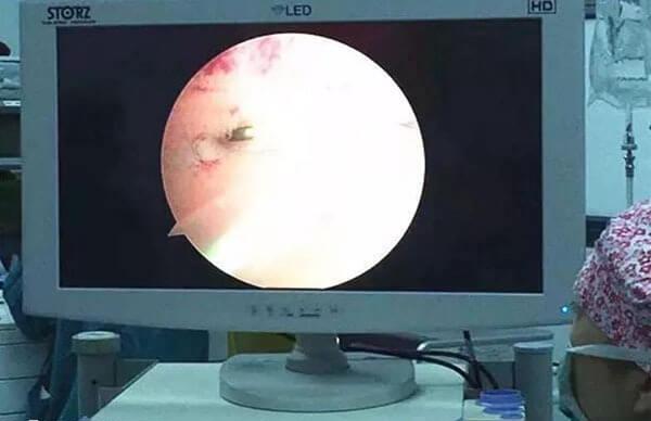 宫腔镜检查不需要住院