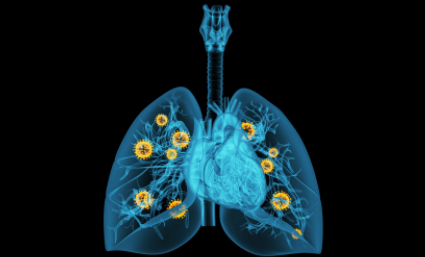 了解肺癌早期症状和前兆，早期筛查项目有哪些