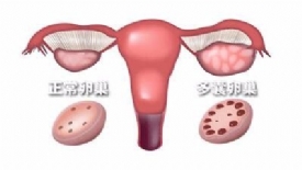 如何判断是多囊卵巢？是不是多囊卵巢就得做手术？