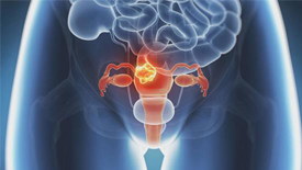 卵巢病变会导致女性不孕？