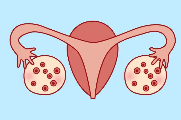 多囊卵巢备孕该怎么做？这四点可提高备孕的成功率