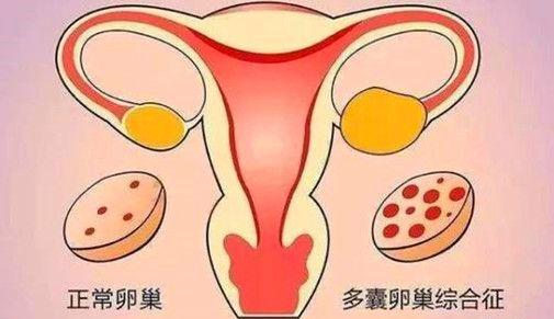 正常卵巢与多囊卵巢综合征的区别