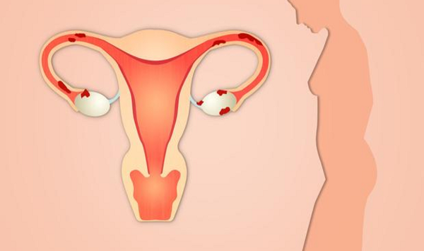 女性要保护好自己的卵巢