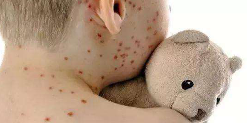 宝宝感染梅毒的症状图图片