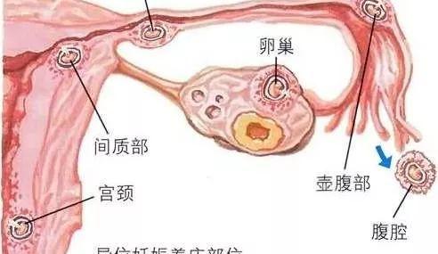 胚胎着床位置解析