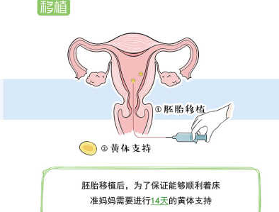 试管婴儿胚胎移植