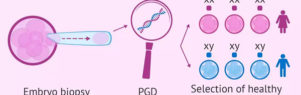 PGD能诊断单基因缺陷诱发的疾病
