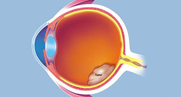 视网膜母细胞瘤会扩散