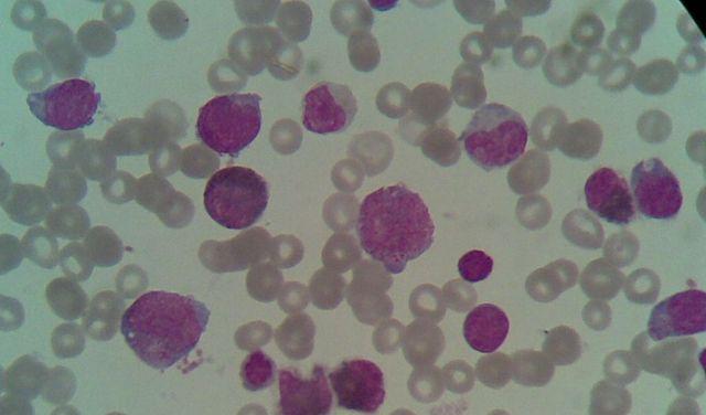 PDGFRA相关的慢性嗜酸性粒细胞白血病