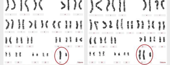 克氏综合征患者染色体报告