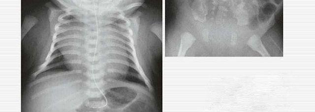先天性脊柱骨骺发育不全