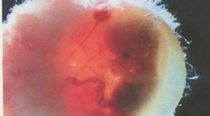 流产组织（胎儿和绒毛）