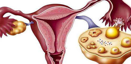 多囊卵巢综合征试管婴儿注意事项
