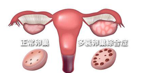 多囊卵巢综合征怀孕