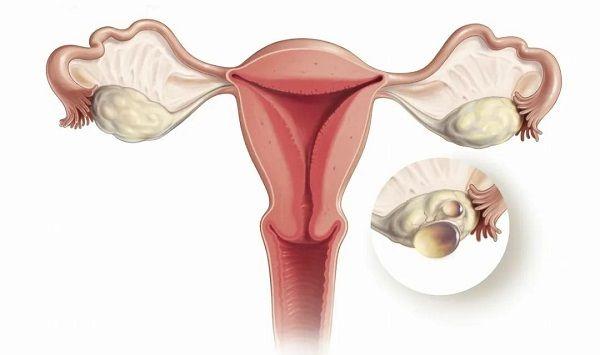 排卵功能紊乱或丧失是多囊卵巢的一大表现