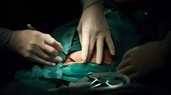 剖腹产手术流程