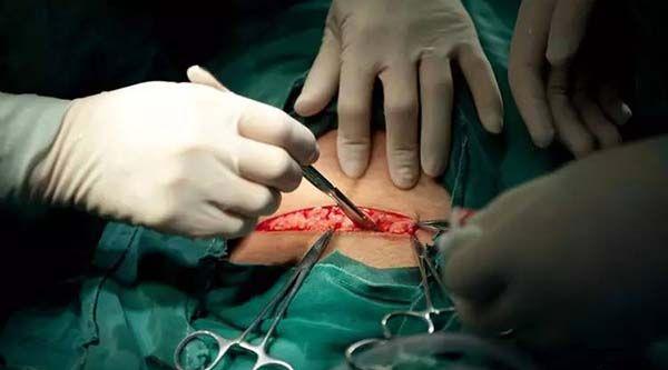 剖腹产手术分娩流程
