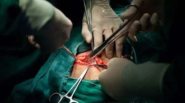 剖腹产手术分娩步骤