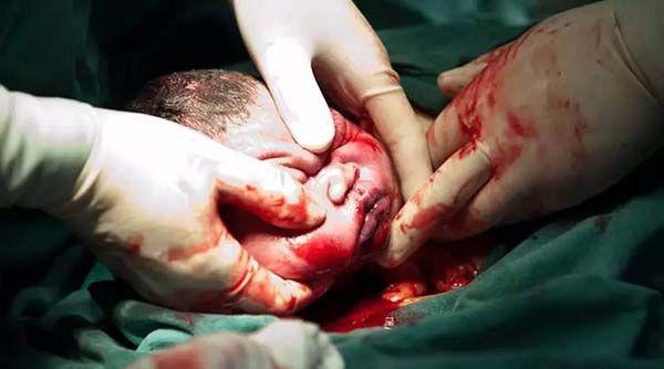 剖腹产胎儿诞生过程