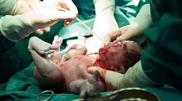 剖腹产胎儿出生过程