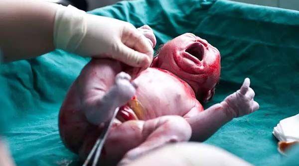 剖腹产胎儿出生流程