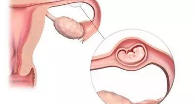宫外孕-输卵管妊娠