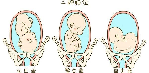 图解三种胎位