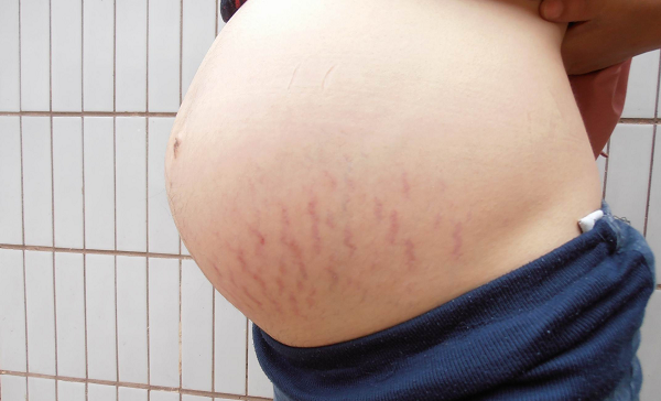 孕期妊辰纹