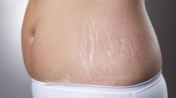 妊娠纹是一种比较顽固的疾病