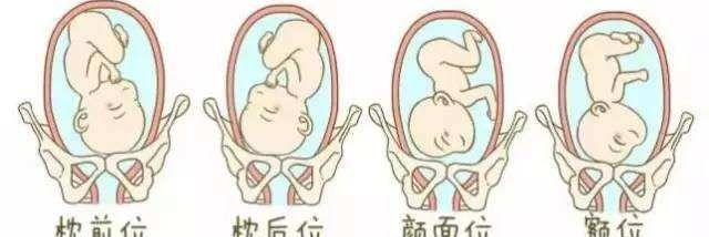 胎儿体位