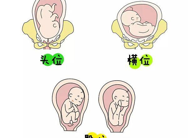 胎儿常见的胎位"
