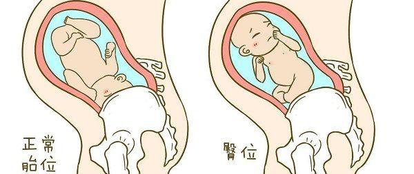 正常胎位和臀位对比图