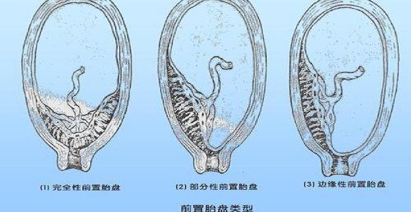 前置胎盘对孕妇及胎儿的危害性都是非常大的