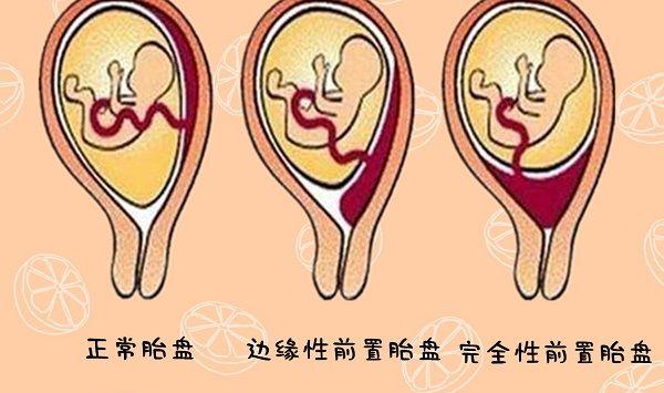 孕妇出现反复性无疼阴道出血要警惕